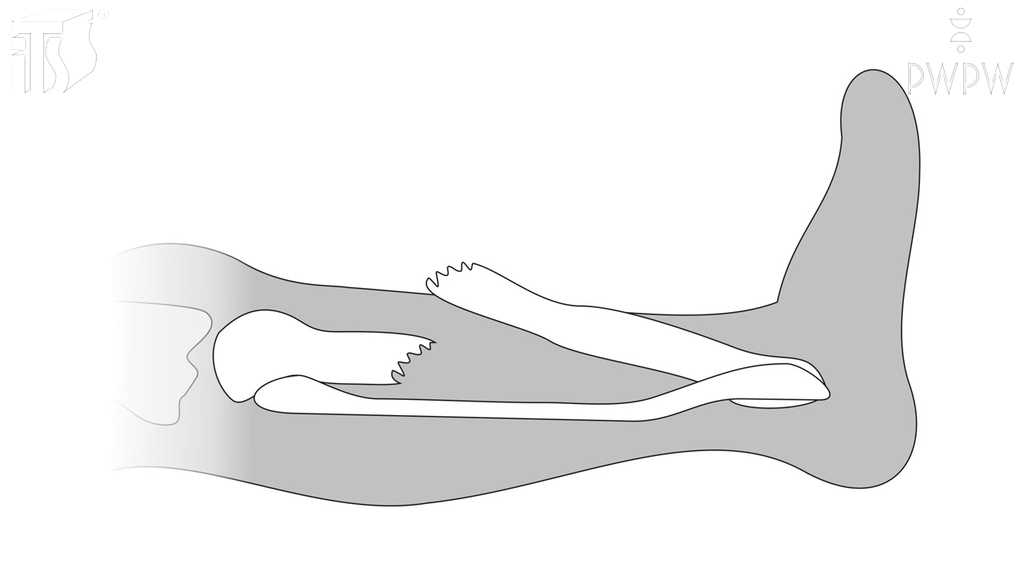 Was sollen Sie bei einem offenen Knochenbruch machen?